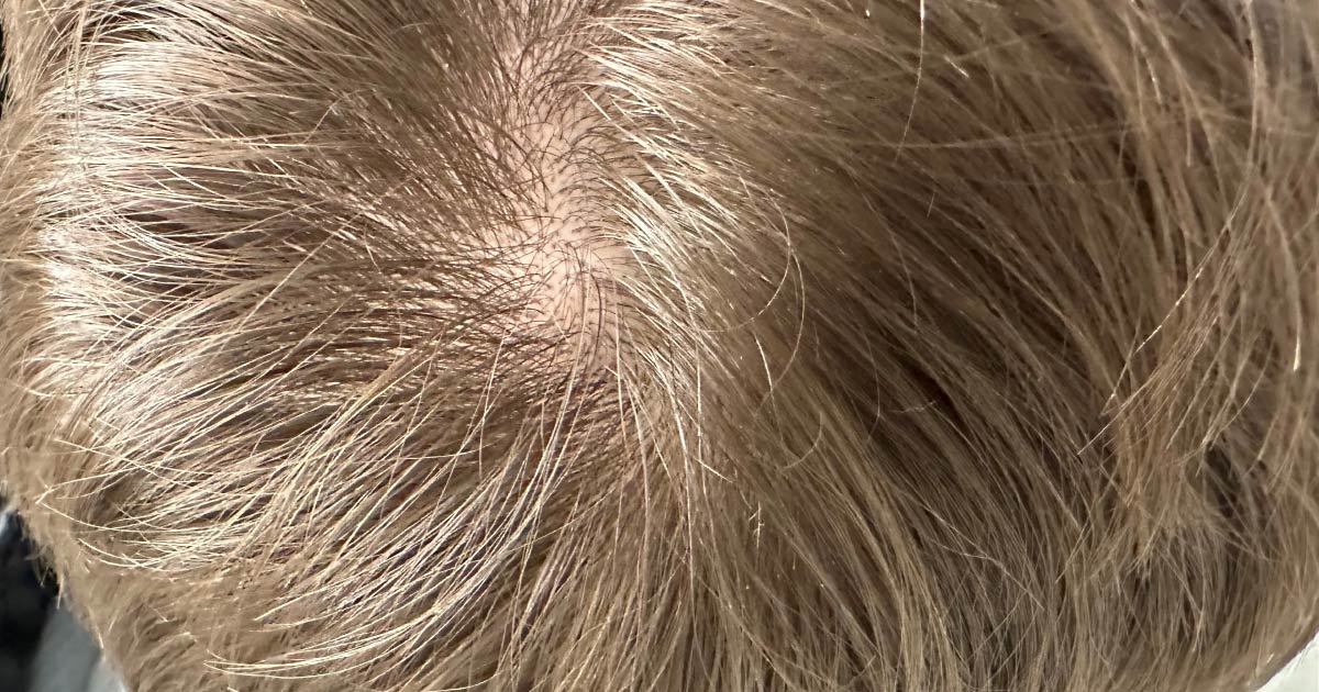 Folliculitis
